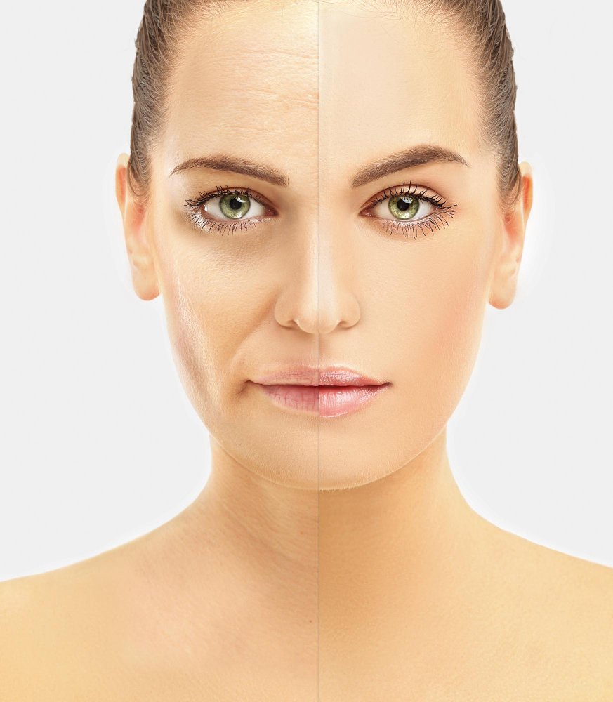 Подтяжка лица фейслифтинг в клинике Cayra Clinic Турция