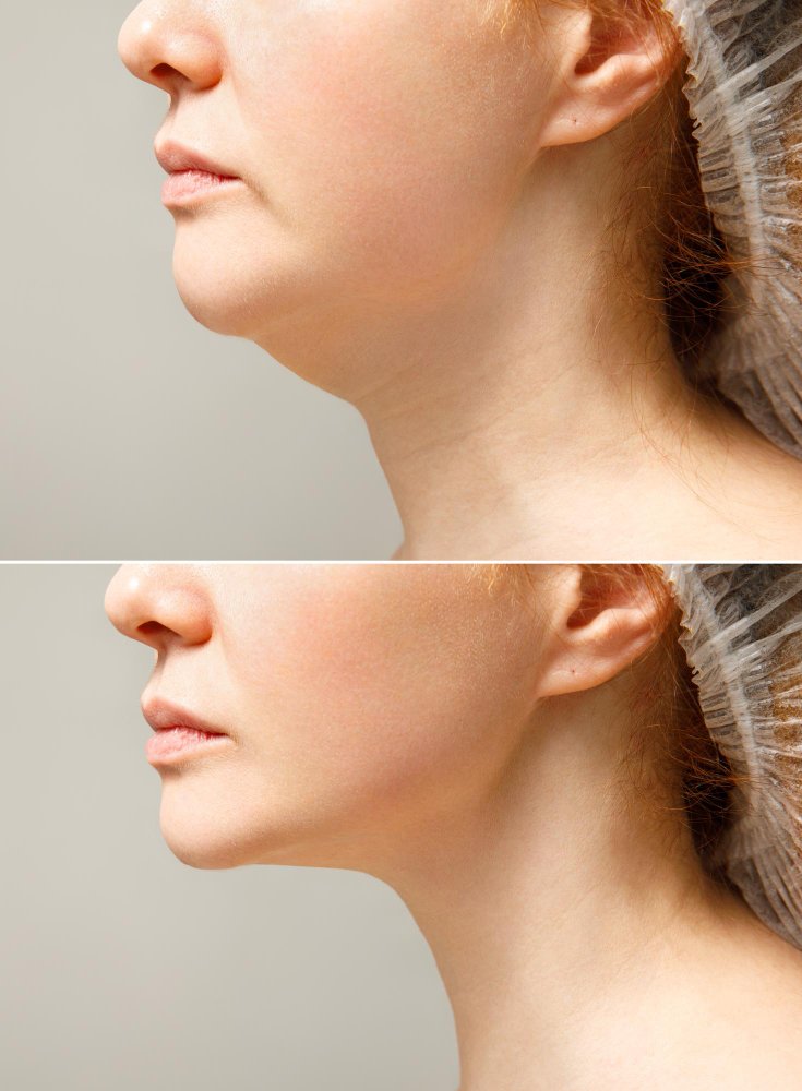 Подтяжка лица и ринопластика в клинике Cayra Clinic Турция