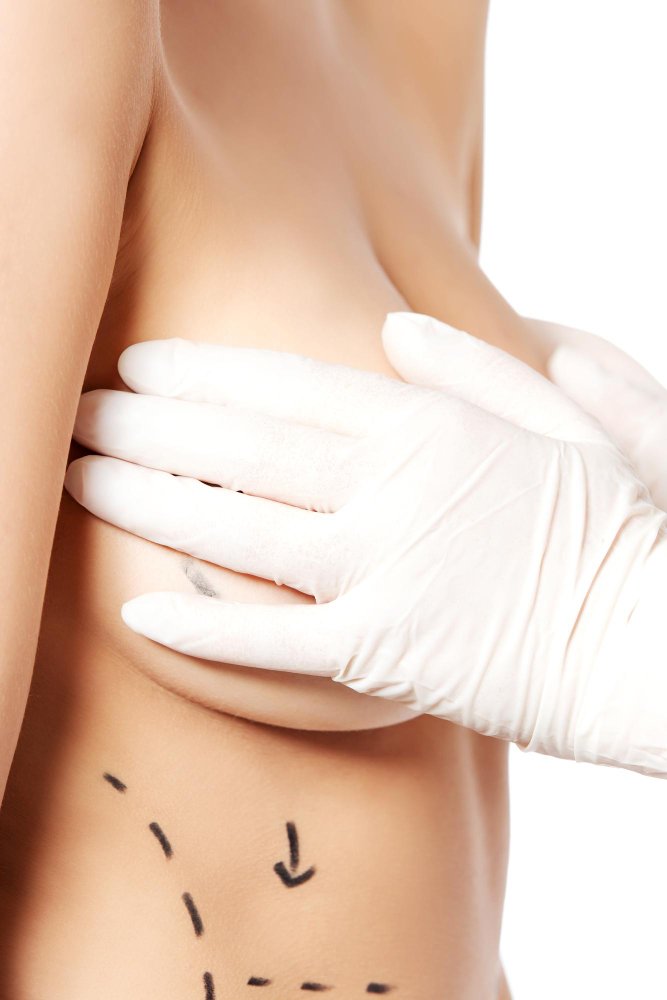 Степени птоза груди — определение перед мастопексией в Cayra Clinic
