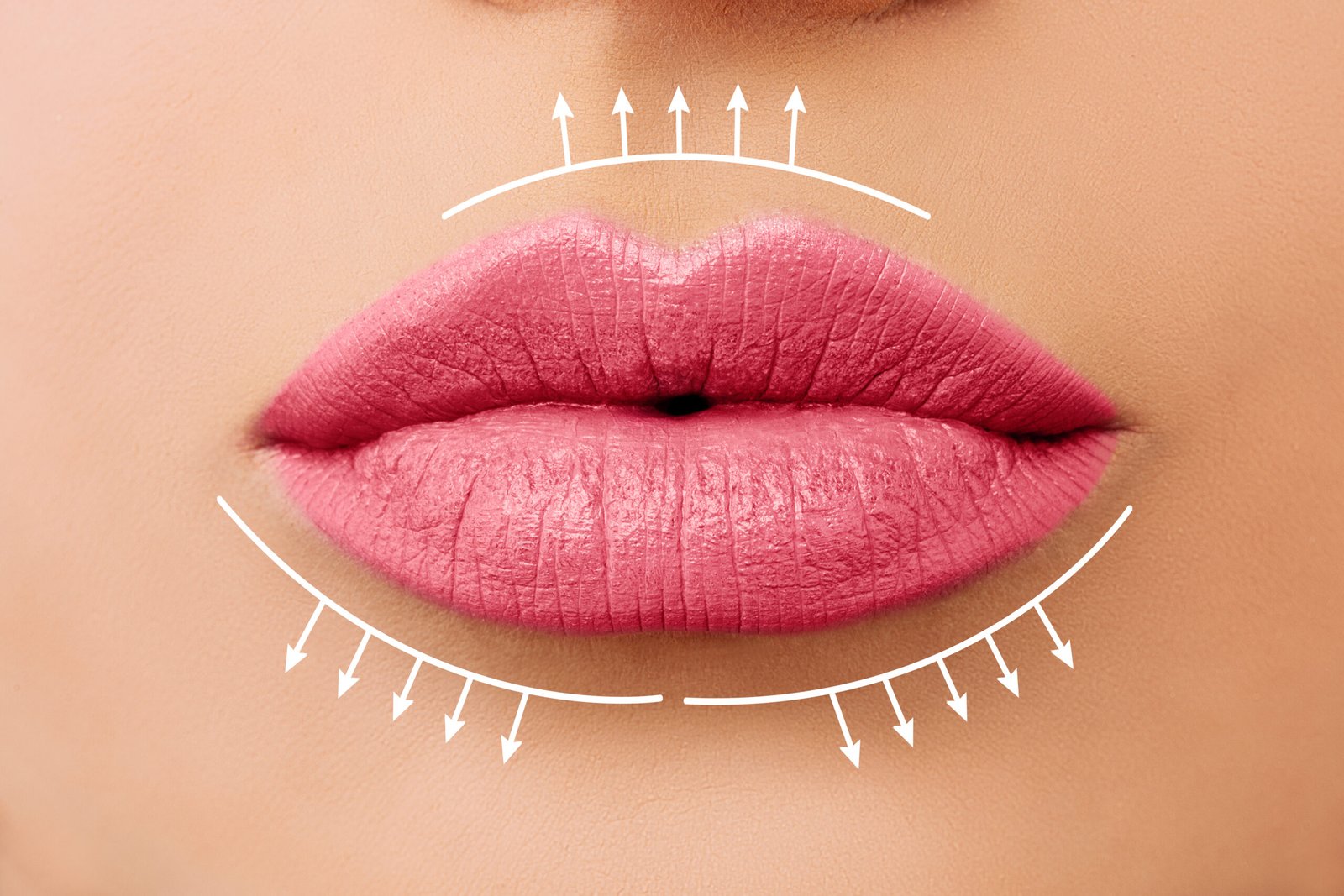 Создание формы плоского банта в технике Russian Lips косметологом Cayra Clinic Стамбул