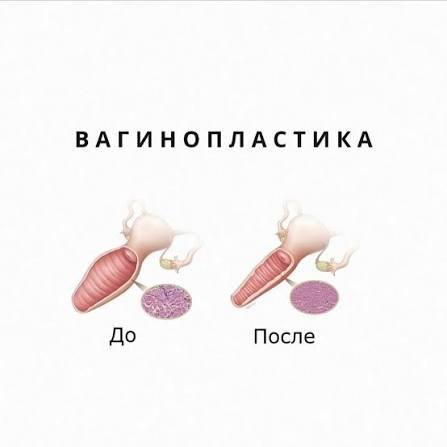 вагинопластика