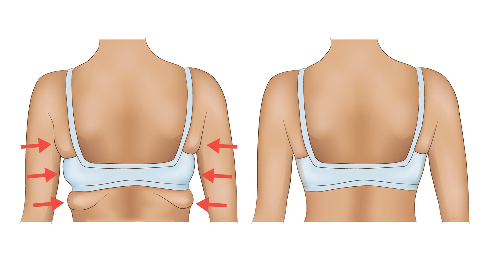 Верхняя подтяжка спины Upper Back Lift в Cayra Clinic Турция