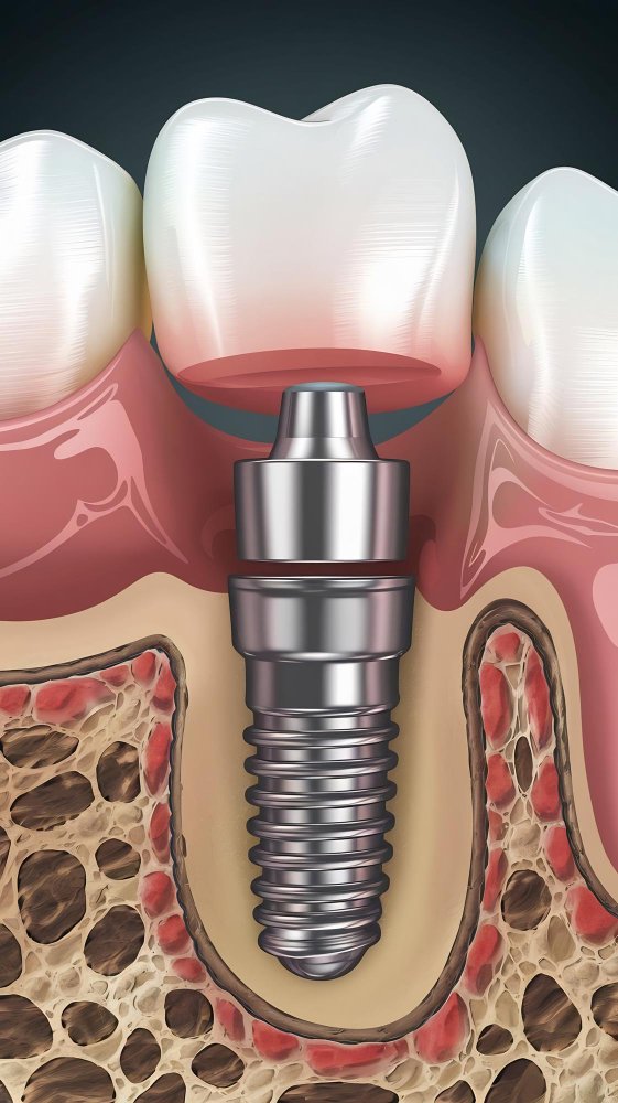 Протокол Quad Zygoma — четыре скуловых импланта в клинике Cayra Clinic