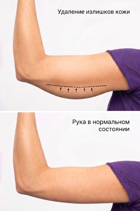 Брахиопластика Турция